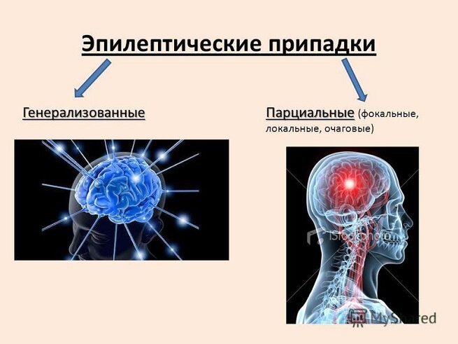 Информационный портал по эпилепсии