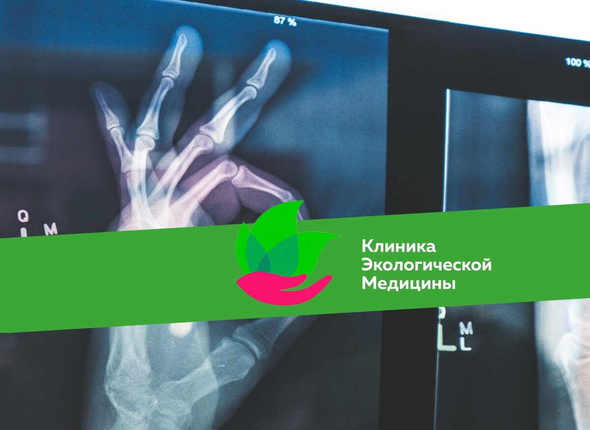 Ренгеноконтрастные желчные камни имеют плотность от 83 HU