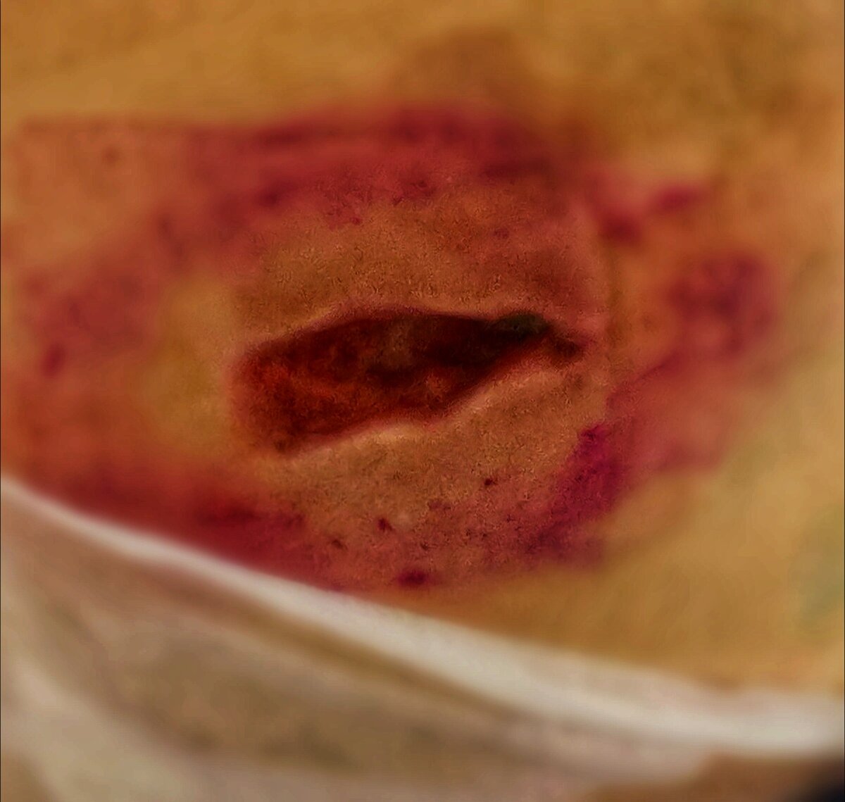 Пролежни образуются на теле маломобильных больных 