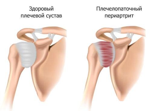Структуры,  образующие непосредственно сам сустав (головка плечевой кости,  суставная поверхность лопаточной кости и гиалиновый хрящ ) не вовлекаются в воспалительный процесс и не деформируются, в отличие от суставной капсулы и сухожильно-связачного аппарата, которые являются главной мишенью данного заболевания.