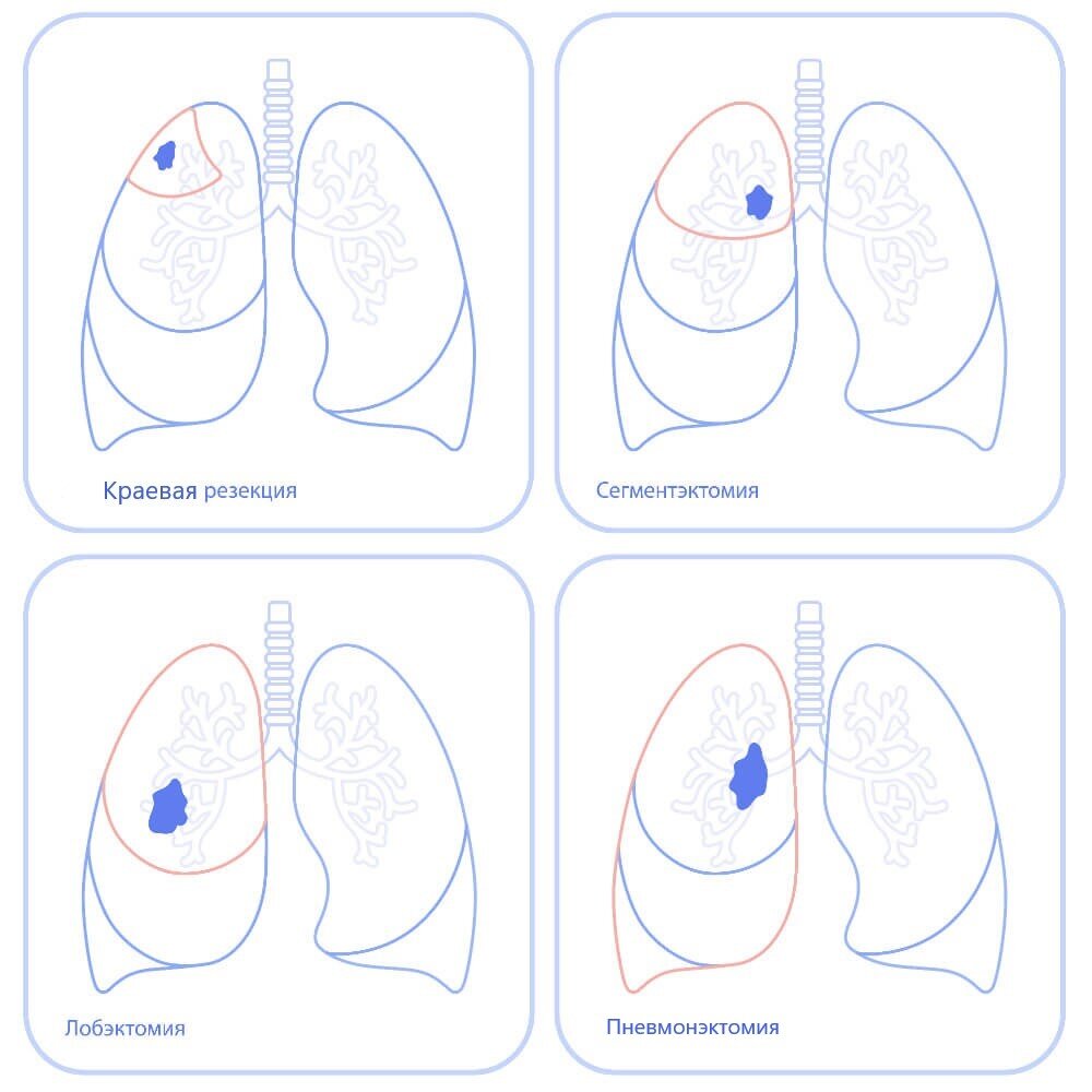 Операция лобэктомия верхней доли левого легкого. Лобэктомия и пневмонэктомия. Лобэктомия верхней доли легкого. Лобэктомия и пневмонэктомия. Лобэктомия левого легкого.