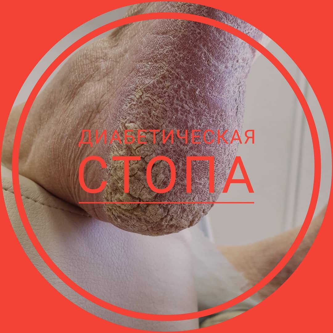 Педикюр при сахарном диабете