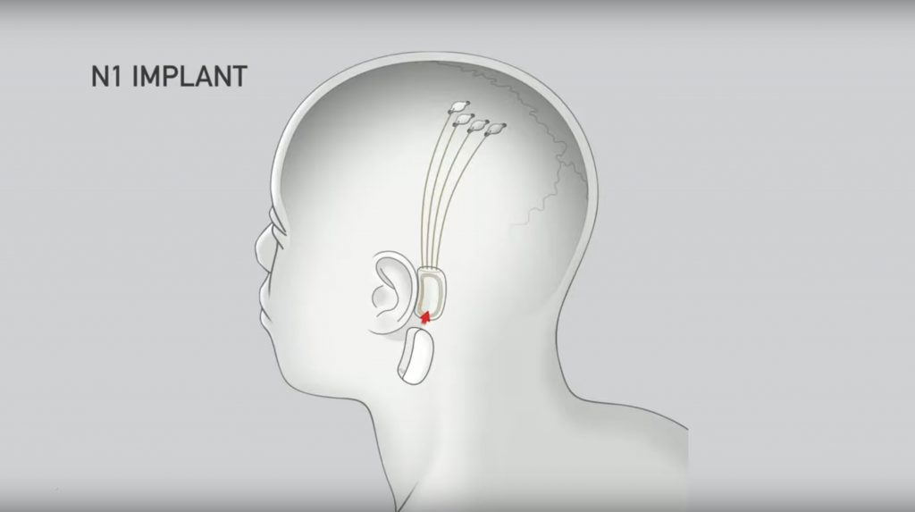 Чип N1 соединяется непосредственно с мозгом, уворачиваясь от кровеносных сосудов и вен, создавая «нервный шнур». (Фото: Neuralink)