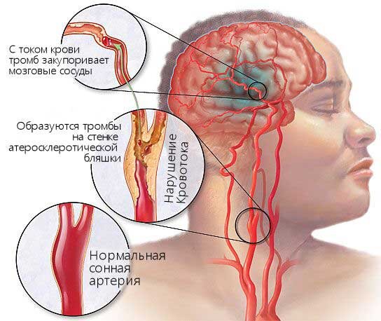 3. Кластерная головная боль