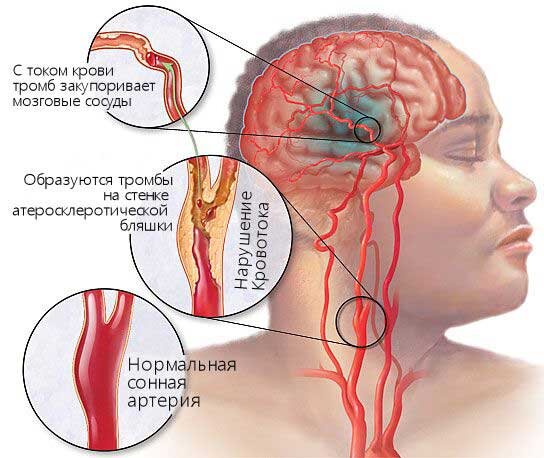 Клинические проявления