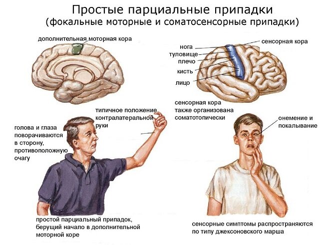 Абсанс