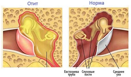 Продуло ухо и болит голова, как лечить?