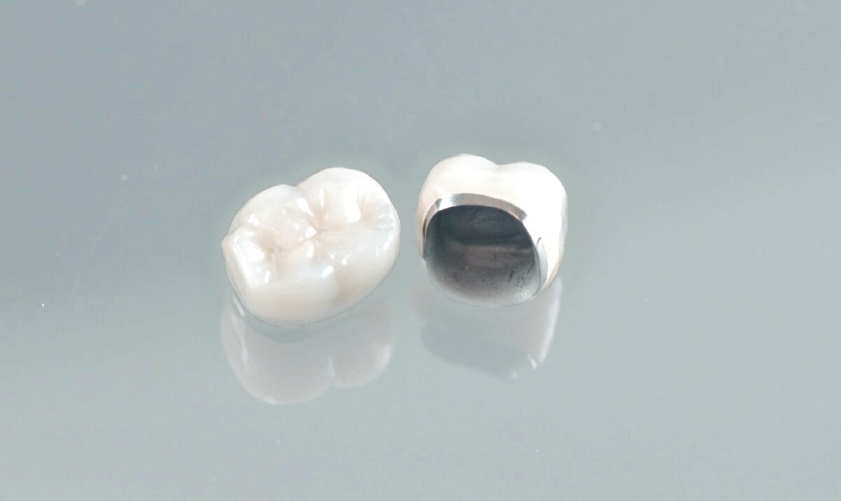 Зубные коронки на имплантах: как ставят и какие лучше?