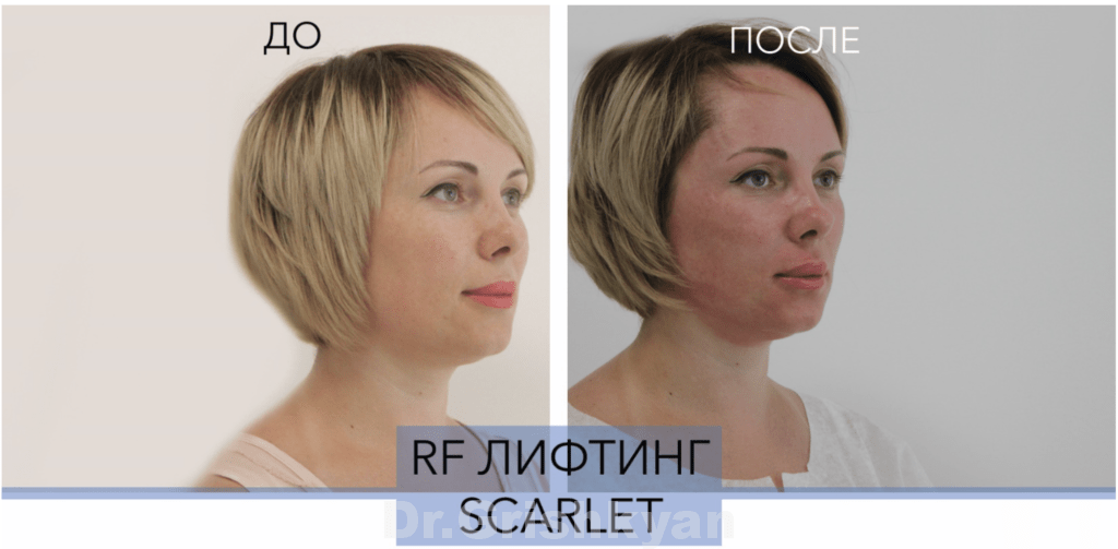 RF-лифтинг Scarlet. Фото взято с сайта клиники Д.Р. Гришкяна. Имеются противопоказания, требуется консультация специалиста.