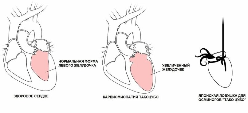 Схематическое изображение кардиомиопатии такоцубо (A) в сравнении с нормой (B).