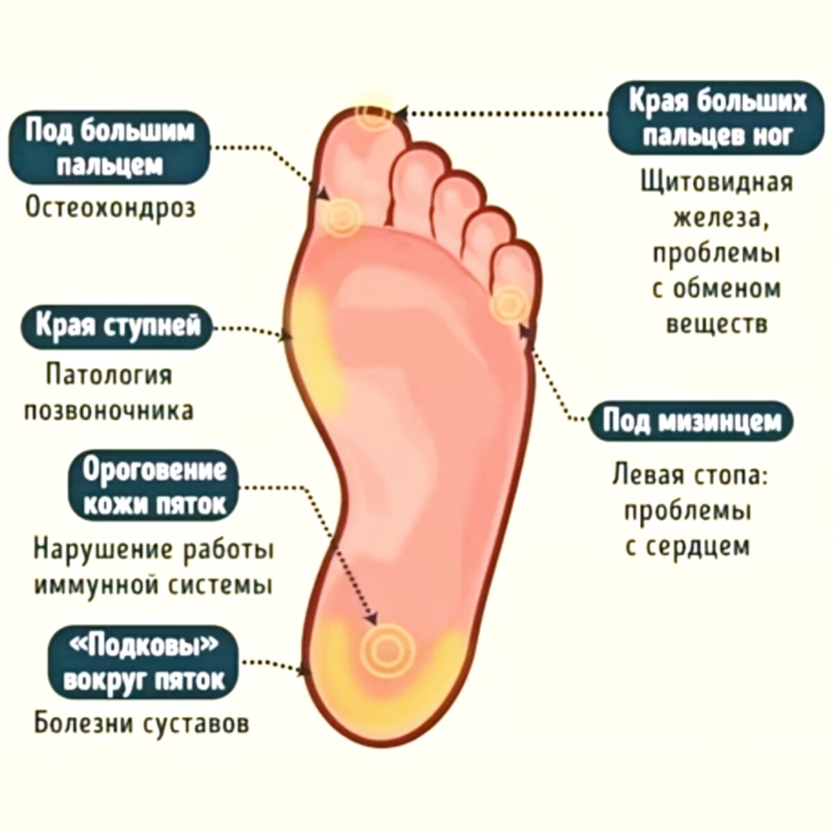 Как выглядит мозоль на ноге