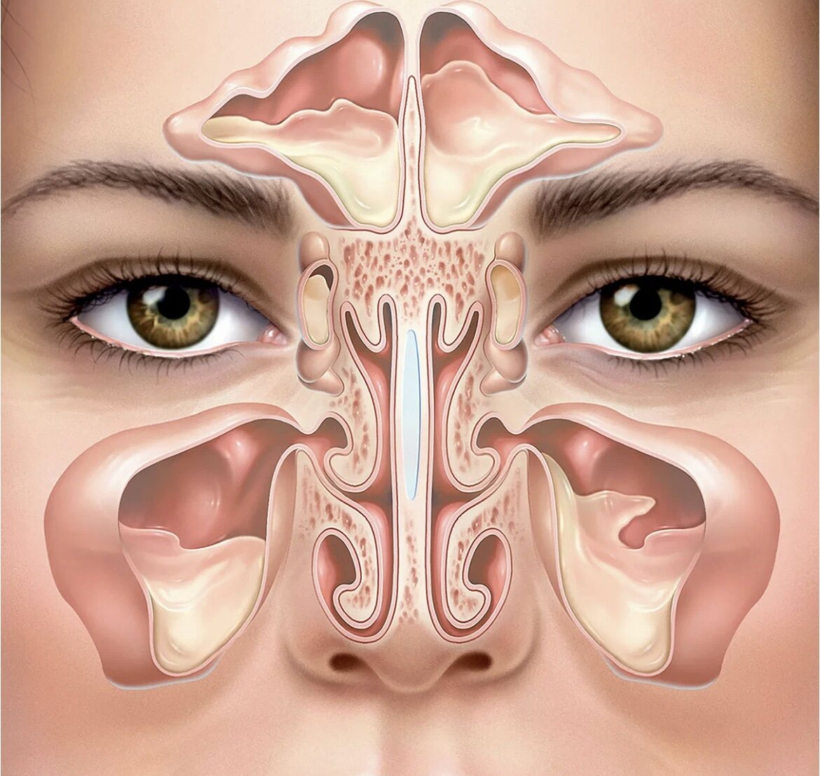 В моем случае вся проблемы у меня была в пазухах на щеках, особенно справа. Пазуха была большого размера и сдавила все другие. Перекрыв проход слизи из других пазух 