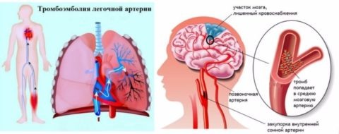  Органы-мишени, которые поражаются тромбозом