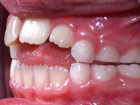  Пример того как выглядит аномальный прикус