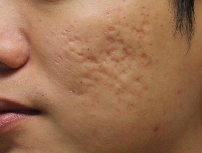 [caption id="attachment_846" align="aligncenter" width="395"] Рубцы после акне[/caption]