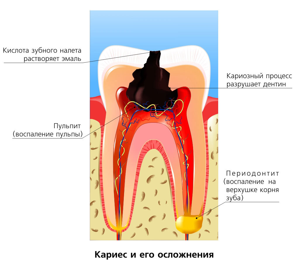 пульпит молочного зуба фото