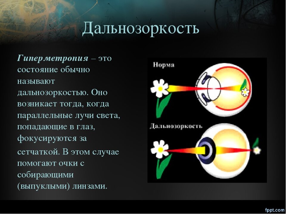 Гиперметропия это. Дальнозоркость. Дальнозоркость биология. Дальнозоркость презентация. Презентация на тему дальнозоркость