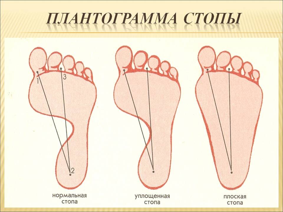 Плоская стопа картинки