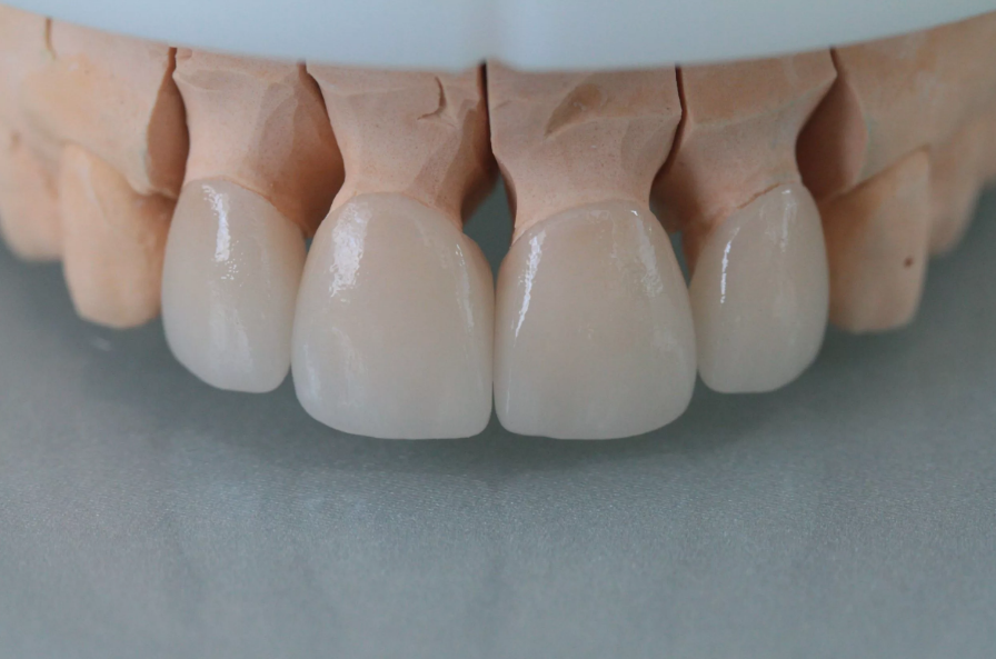 Безметалловая керамика диоксид циркония. Коронка из композита. Коронка из композитного материала. Коронка из композита. Коронка из композита.