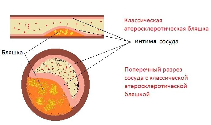 Бляшка это