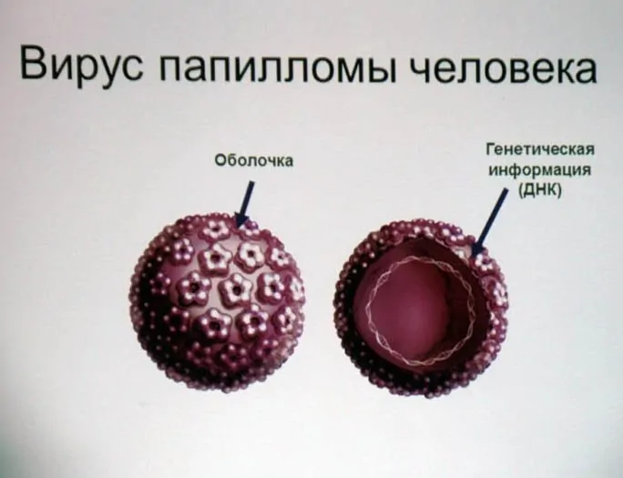 Папилломы на головке члена