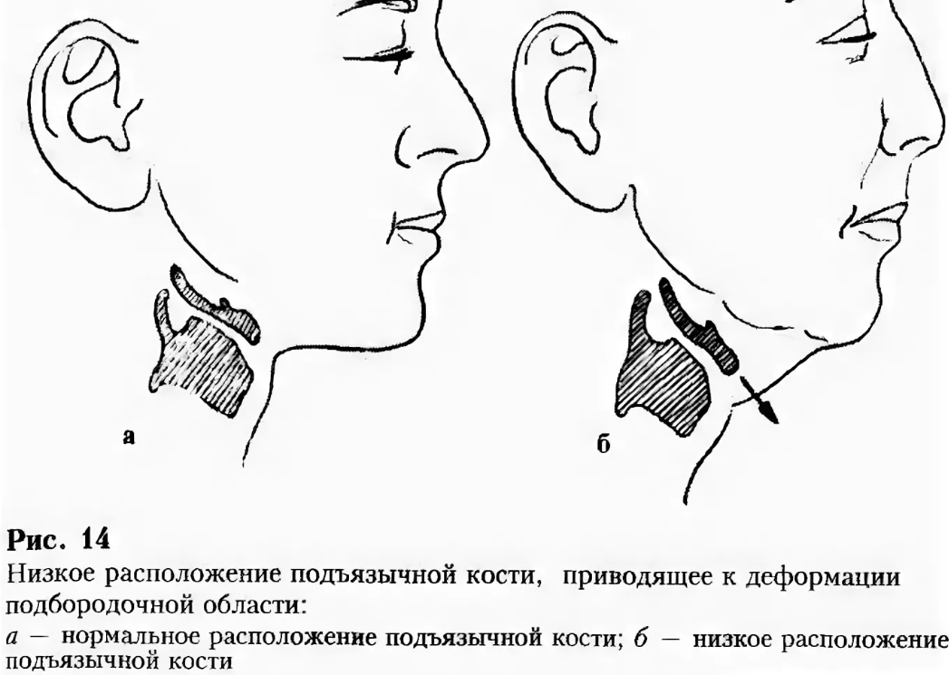 Ниже расположена. Низкое положение подъязычной кости. Расположение подъязычной кости. Положение подъязычной кости. Подъязычная кость расположение.