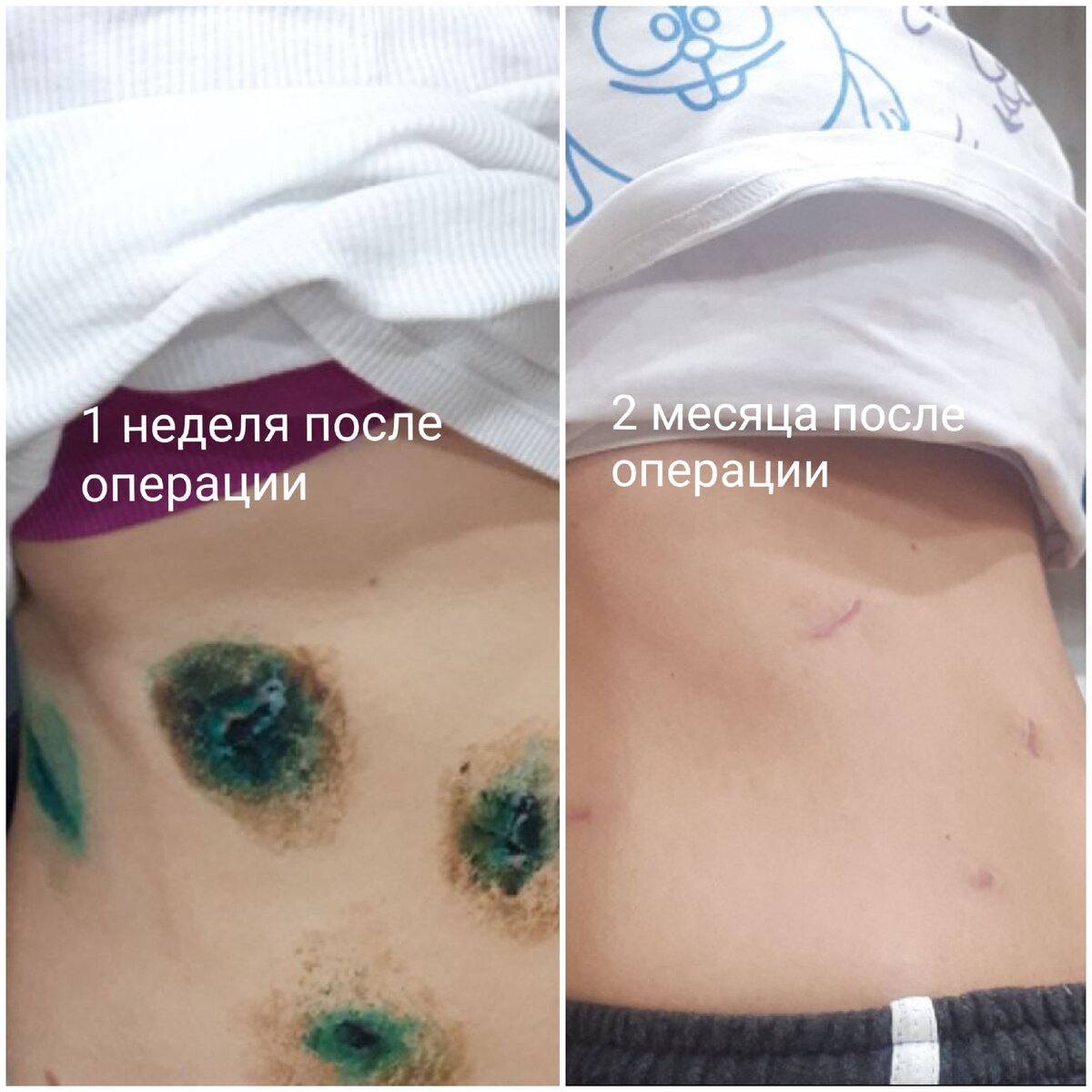 Всего 4 прокола 