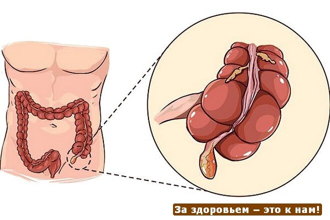 Слепая кишка