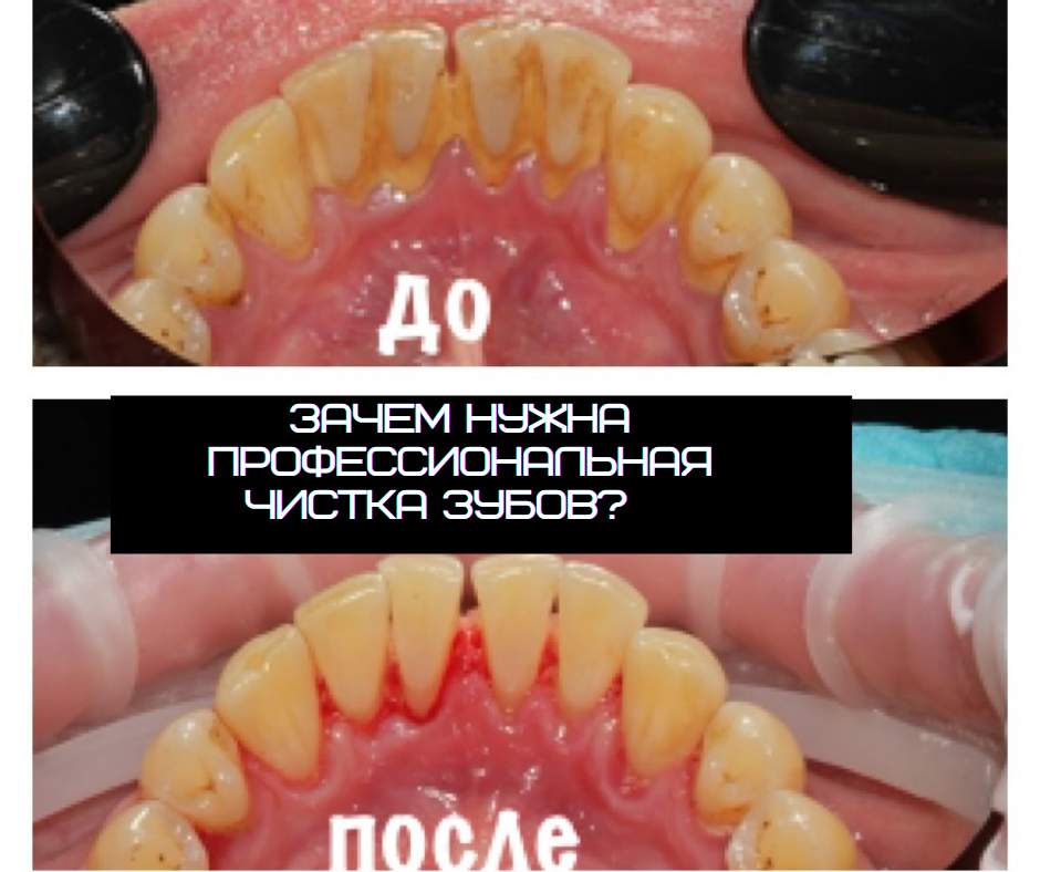 Зачем нужна профессиональная чистка зубов?👩🏻‍🔬

Я очень часто слышу от пациентов : «ну я же чищу зубы, зачем делать то же самое у стоматолога, ещё и платить?» 🤷‍♀️
Заметила интересную вещь : этот вопрос обычно возникает у людей, которые ещё ни разу не делали чистку зубов 😬
⠀
Объясню👇🏻😌
⠀
🚫Отвердевшие зубные отложения на эмали не беспокоят, но с течением времени начинают доставлять все большее неудобство – появляется неэстетичный налет коричневого цвета, запах изо рта, улыбка становится не красивой и даже отталкивающей🤭
⠀
⚠️Профгигиена зубов необходима в целях защиты полости рта от бактерий и, соответственно, от образования мягких, а затем твердых зубных отложений.
⠀
После процедуры пациенты отмечают ощущение особой свежести и чистоты во рту 🌬
Зачем проводить чистку зубов и как часто❓
⠀
⚠️Профессиональная чистка является обязательным этапом лечения при пародонтите.
⚠️при установке протезов и брекет-систем.
⚠️имплантации.
⚠️в качестве профилактики.
⠀
Желательно делать профессиональную чистку каждые пол года ☝️
⠀
А когда Вы делали профгигиену полости рта и делали ли вообще ?)😉
⠀
✏️Записаться можно в Директ..
