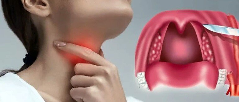 Признаки, причины и лечение фарингита
