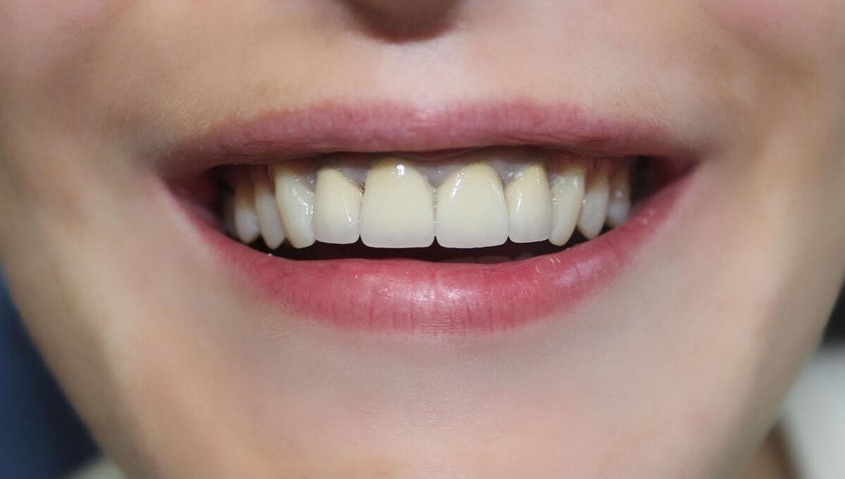Десна отошла от зуба: что делать, как лечить | Dental Art