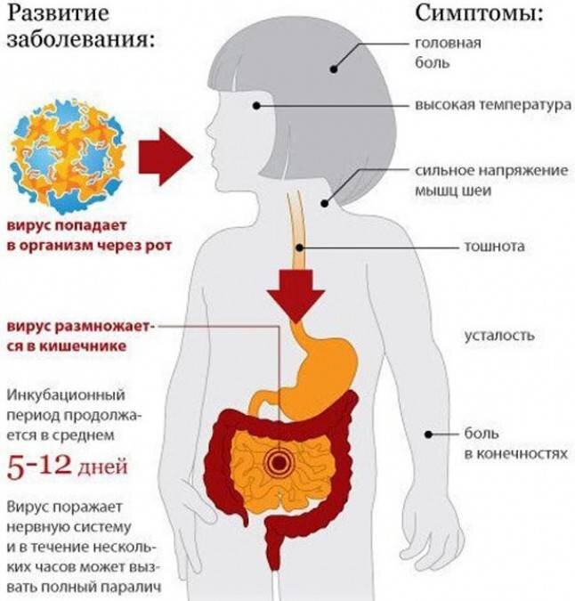 паралитическая форма полиомиелита. абортивная форма полиомиелита. полиомиелит симптоматика. источником инфекции при полиомиелите является:. заражение полиомиелитом симптомы.