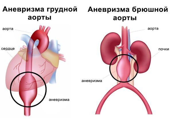 Аневризма восходящего отдела аорты: лечение, операция, стоимость