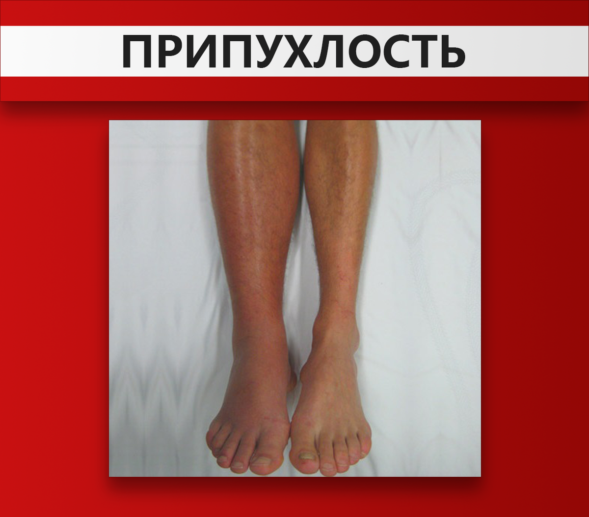 Признаки, указывающие, что в сосудах ваших ног есть тромбы