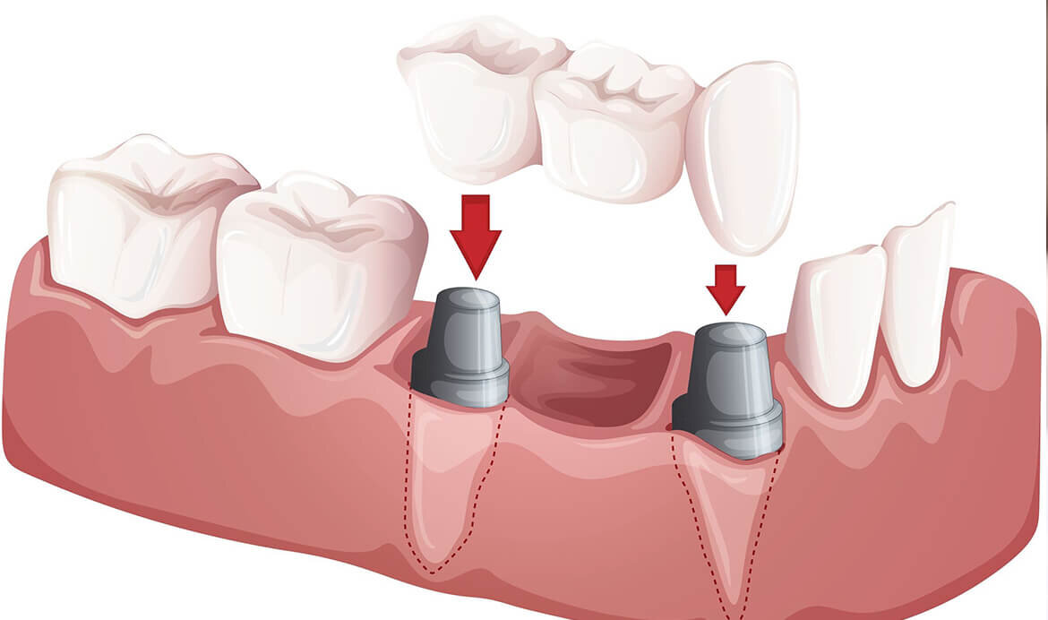 зубной мост что это такое