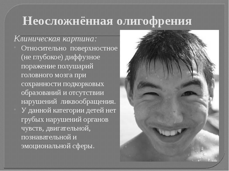 Олигофрения фото симптомы и признаки