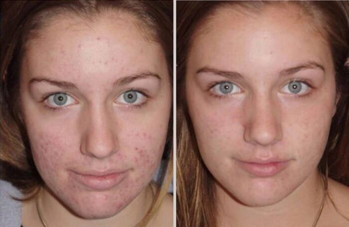 Дегтярное мыло способно устранять прыщи и угри