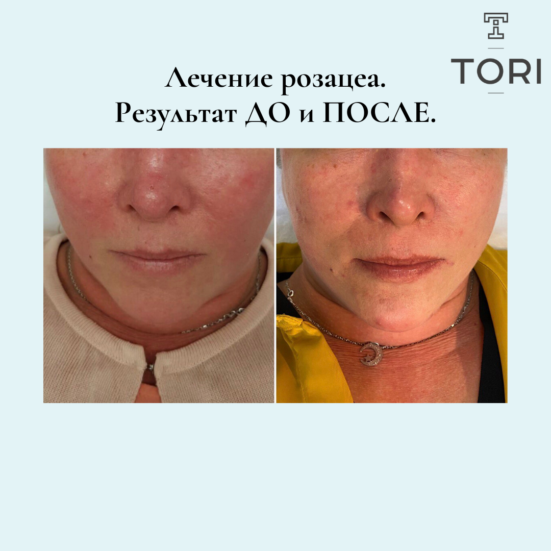 Фототерапия (фотоомоложение) в Москве: цена - от 500 руб., отзывы Клиника Beauty