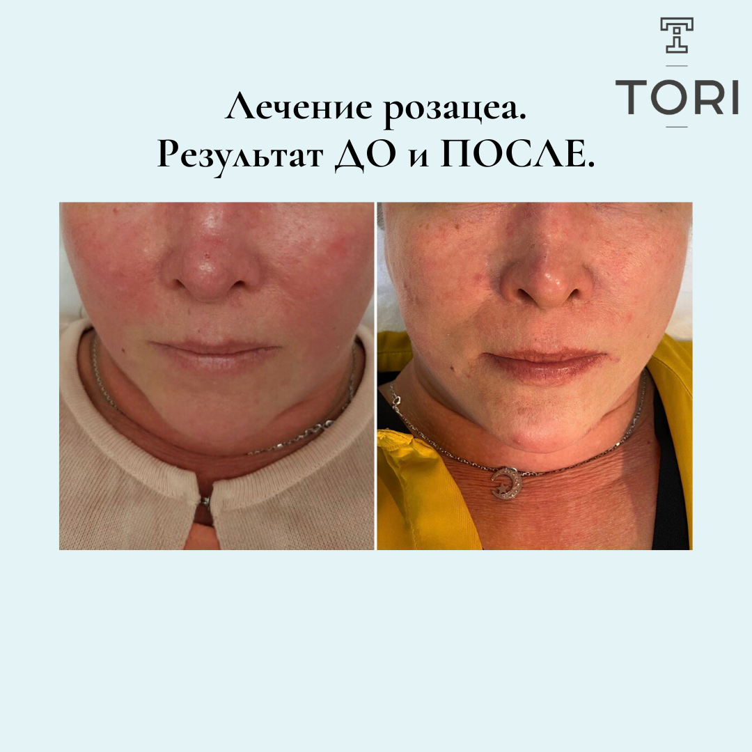 Процедура фотоомоложения BBL. Forever young. | Tori Clinic | Дзен