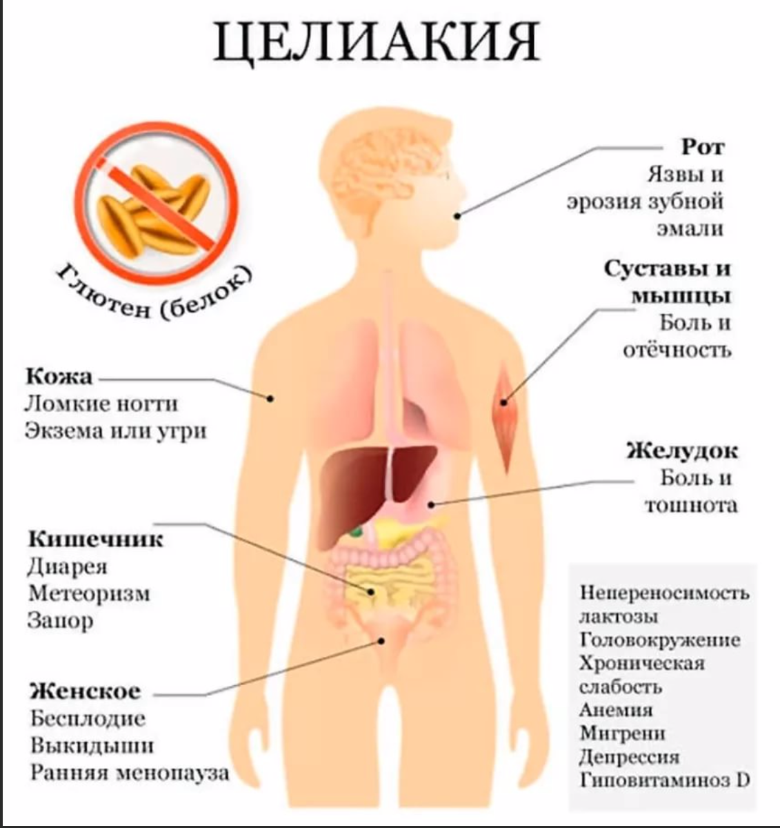 Целиакия: симптомы, причины, осложнения, диагностика и лечение