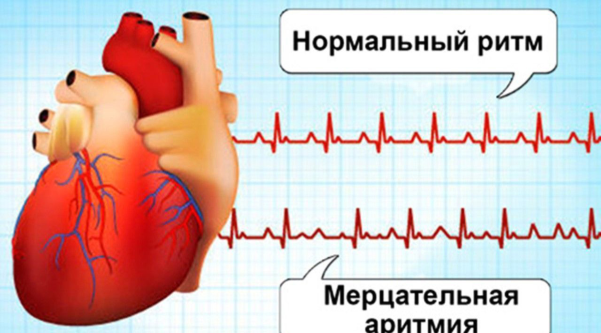 Мерцательная аритмия: без лечения возможны тромбы и проблемы с головным  мозгом | О здоровье: с медицинского на русский | Дзен