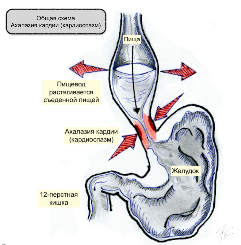 Лечение ахалазии кардии и кардиоспазма