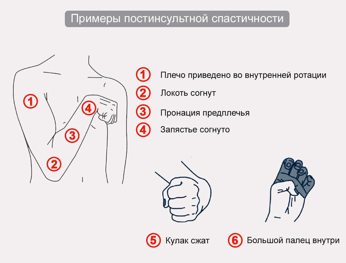 Что такое спастика и как бороться со спастикой мышц | Жизнь и ...