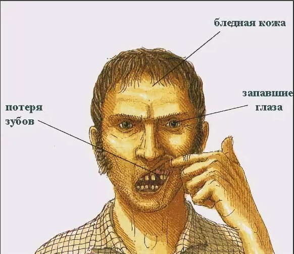 Симптомы цинги. Рисунок взят из сети Интернет