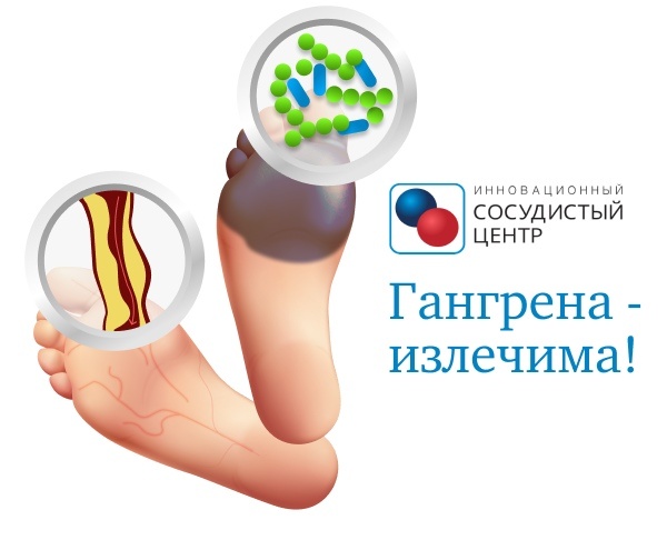 Причины развития гангрены.