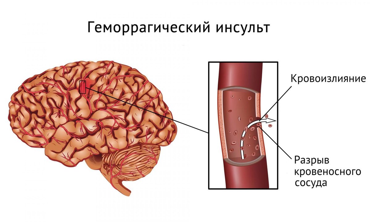 Инсульт у женщин - особенности, причины, симптомы | Наш дом в Новороссийске  | Дзен