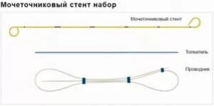 Зачастую применяется ретроградный способ установки дренажа через устья каналов мочевого пузыря с использованием анестезии местного действия. Детям и пожилым мужчинам стент устанавливается под общим наркозом. Если нет возможности установить стент неинвазивно, применяется антеградный способ и формируется нефростома, через которую дренаж расширяет каналы мочеточников.