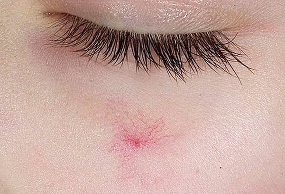 Сосудистые звездочки на лице