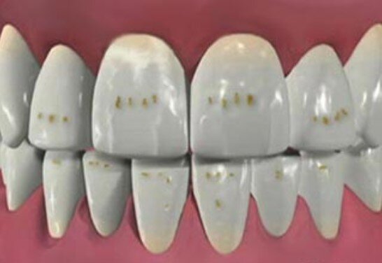 Коричневые пятна на зубах: что это может быть? | Стоматология ROOTT | Дзен