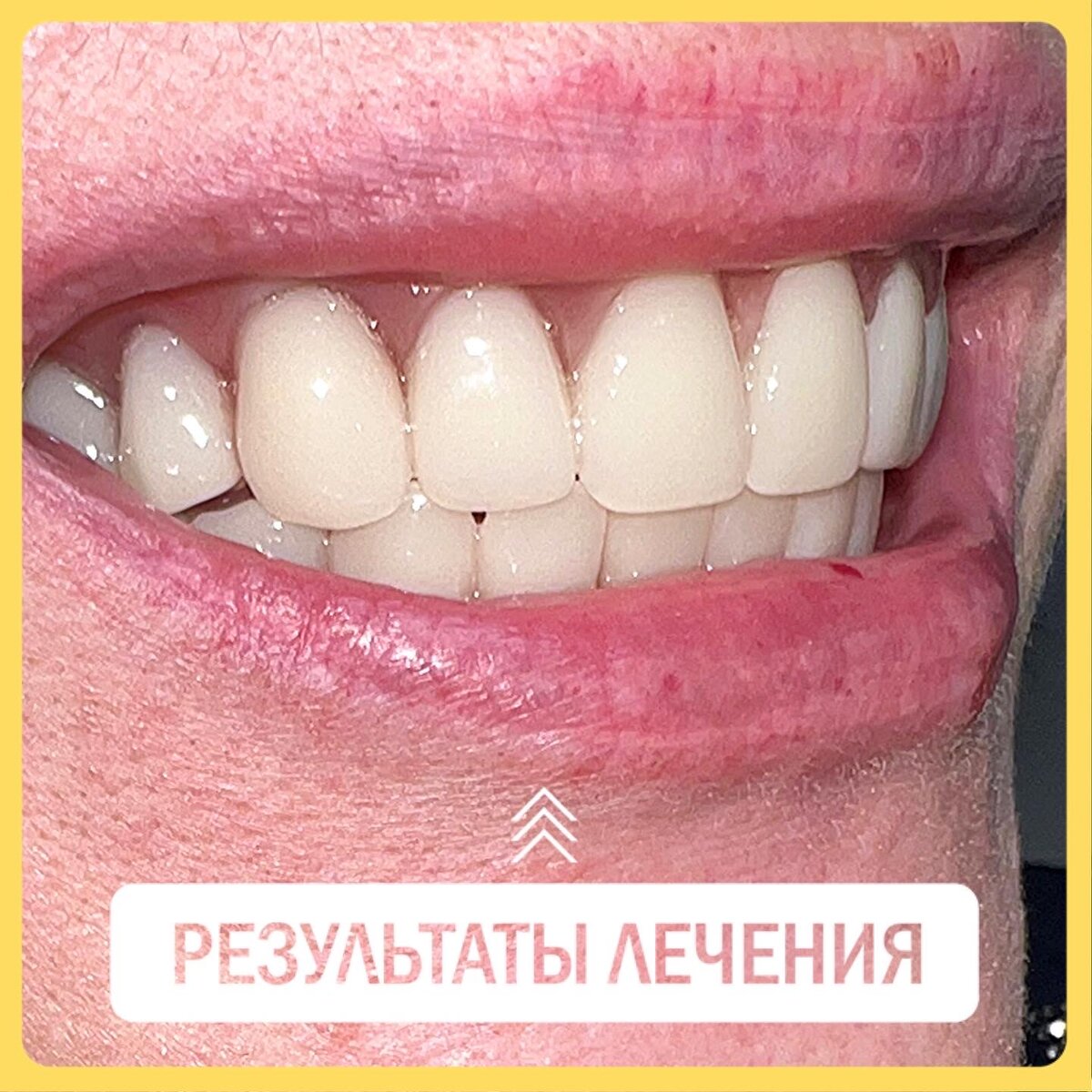 Тотальное протезирование на имплантатах Dentium | Стоматологические ...